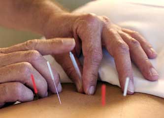acupuntura